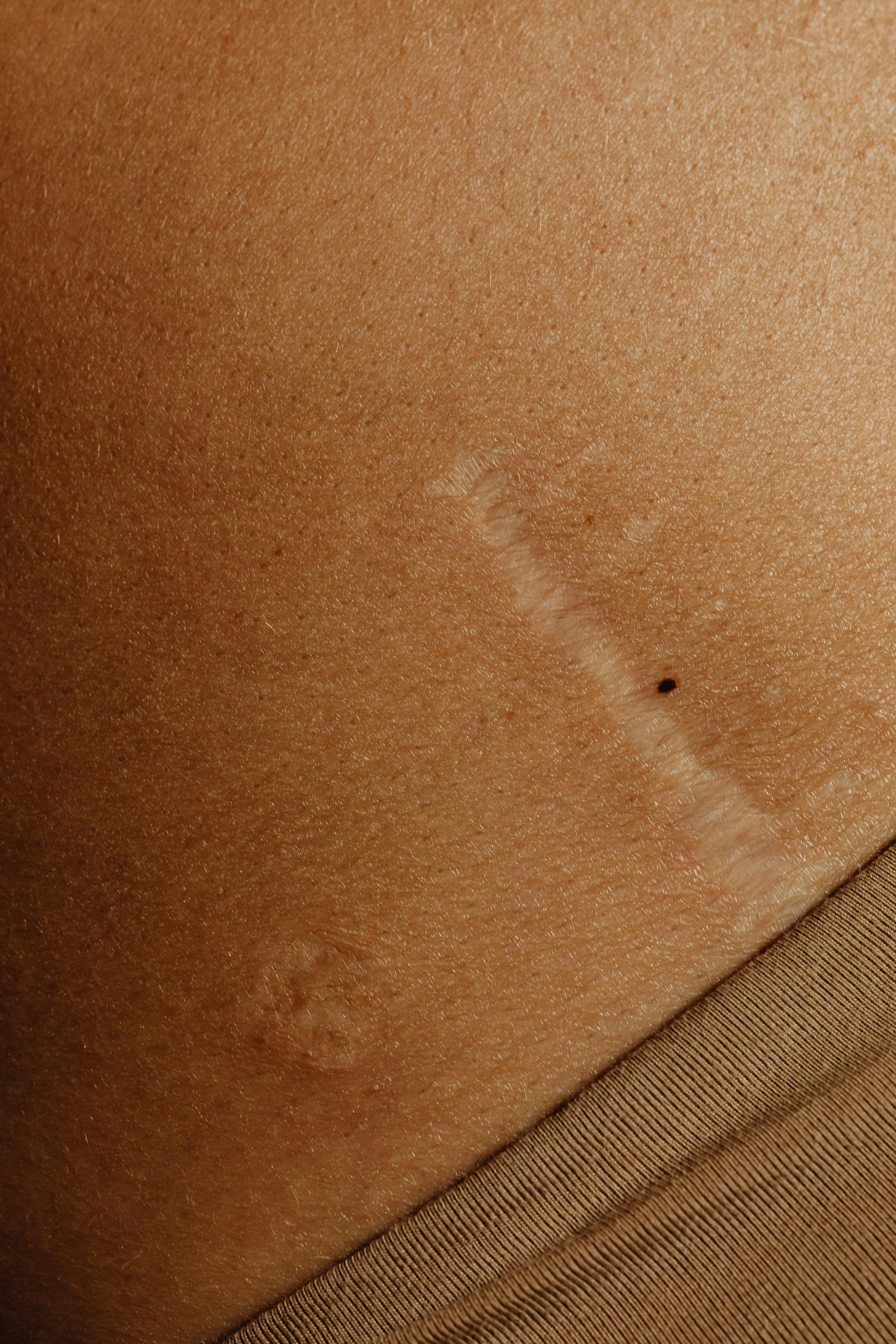 Accidental Scars